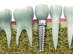 Ӱ푷Nֲ��ֲ���γɵ���������Щ