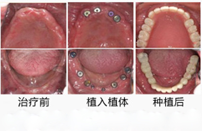 點(diǎn)擊查看源網(wǎng)頁 全口缺失種植牙好嗎