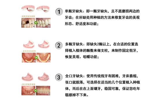 點擊查看源網(wǎng)頁 韓國奧齒泰(OSSTEM)種植牙有什么優(yōu)點