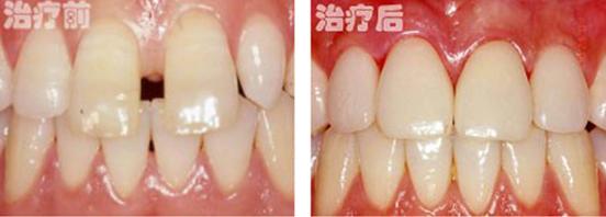 牙齒間隙過(guò)大怎么辦