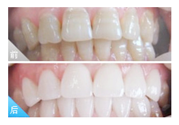 全瓷牙會過敏嗎