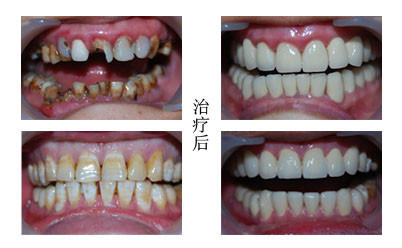 你知道全瓷牙是用什么做的嗎