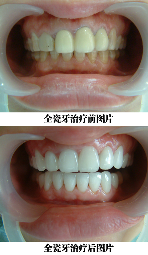 全瓷牙會(huì)對(duì)人體造成傷害嗎