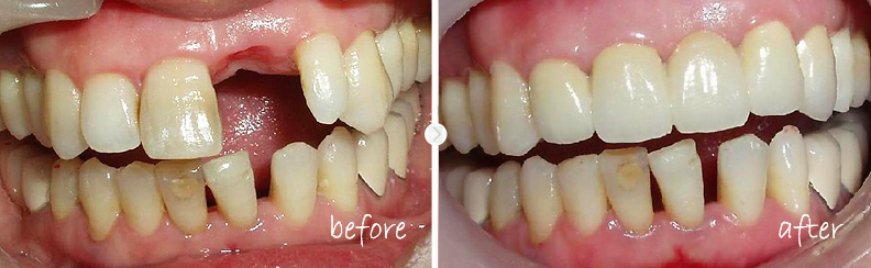 門牙掉了一顆該咋辦