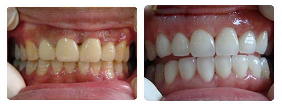 發(fā)黑發(fā)黃的牙齒怎么變白呢