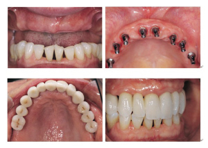口牙齒種植時(shí)間要多久