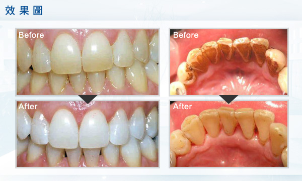 怎么讓抽煙變黃的牙齒變白呢