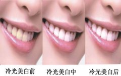 牙齒發(fā)黑發(fā)黃怎么辦