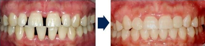 牙齒稀疏分為哪幾個(gè)類(lèi)型