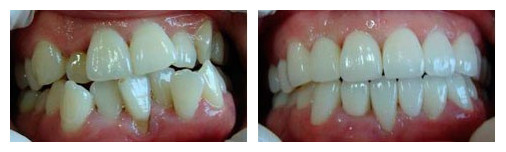 牙齒擁擠怎么辦