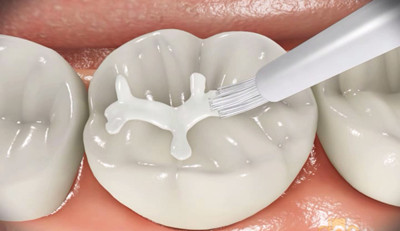 窩溝封閉是如何保護(hù)牙齒