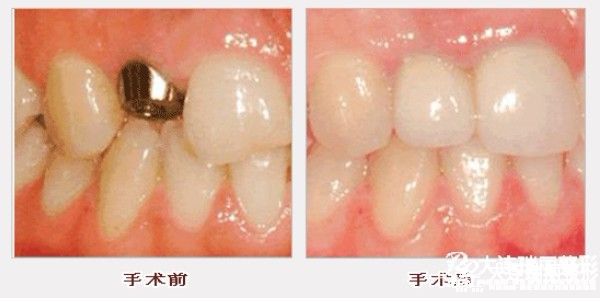 鑲牙材料越貴越好嗎