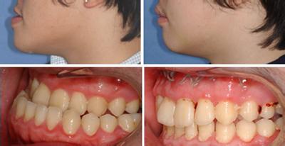 地包天矯正的最佳年齡牙齒