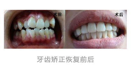 隱形正畸有哪些特點(diǎn)