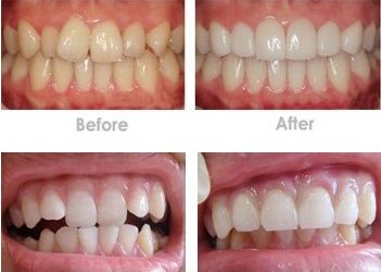 透明隱形矯治器外觀有哪些特點