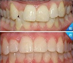 治療牙齒不齊的方法有哪些