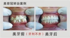 兒童牙齒不齊的原因?