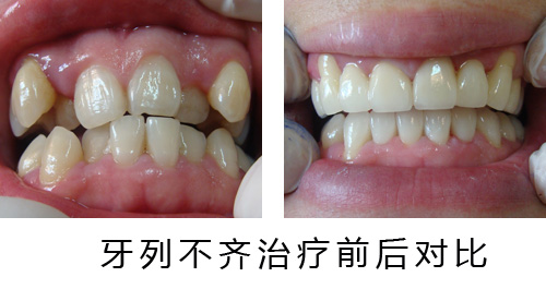引起牙列不齊的原因有哪些