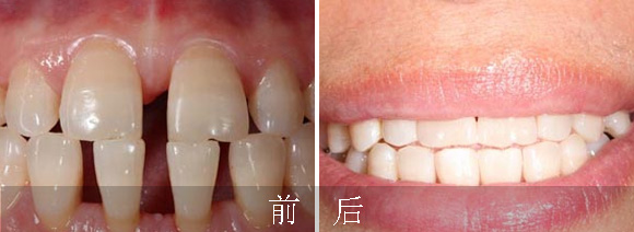 牙齒稀疏怎么辦