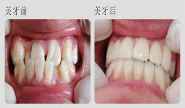 牙齒矯正對牙齒會有危害嗎