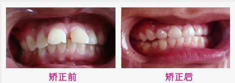 無痛矯正成人牙齒前突