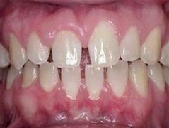 導(dǎo)致孩子牙列稀疏的原因有哪些