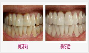 四環(huán)素牙美白價(jià)格是多少