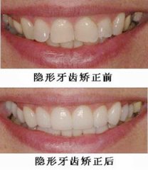 牙齒隱形矯正有哪些優(yōu)勢呢