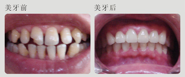 牙縫過(guò)大怎么辦