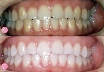 黑黃牙洗牙多少錢