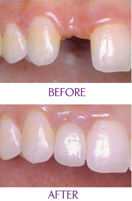 門牙掉了做種植牙好嗎