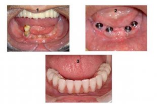 哪種材料適合修復(fù)全口牙齒缺失