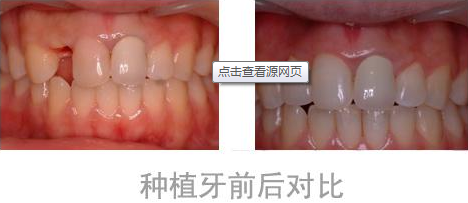 在門牙種植過程中有哪些注意事項