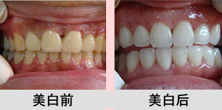 去除煙漬牙的方法有哪些
