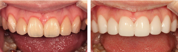四環(huán)素牙如何洗白