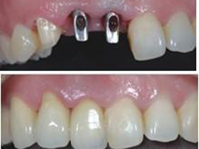 多顆牙缺失修復(fù)哪種材料好