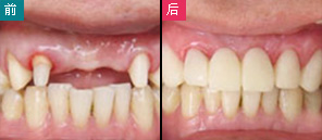 多顆牙缺失怎么修復(fù)