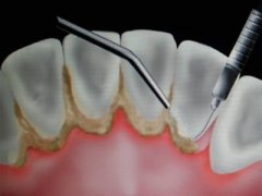 牙周炎的引發(fā)原因有哪些