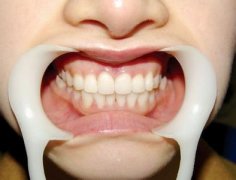 牙周炎是怎么引起的