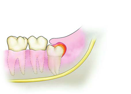 智齒冠周炎表現(xiàn)癥狀有哪些