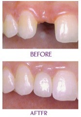 單顆種植牙有哪些優(yōu)點(diǎn)