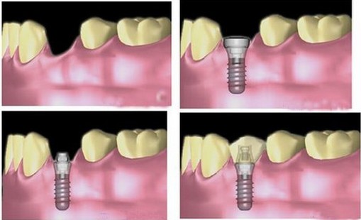 關(guān)于種植牙植骨的基本常識(shí)你知道嗎