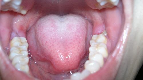 智齒冠周炎的特點有哪些呢