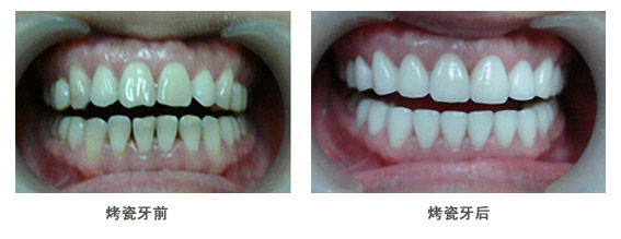 選擇哪種材料做烤瓷牙比較好