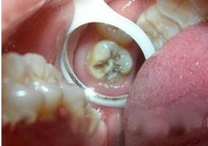 補(bǔ)牙齒多少錢