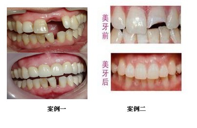 影響美容冠價格的有哪些因素