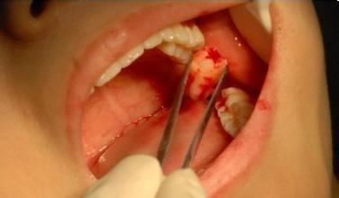 漳州拔牙去哪好