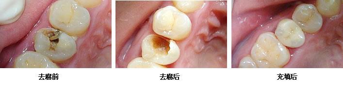 補(bǔ)牙一般多少錢