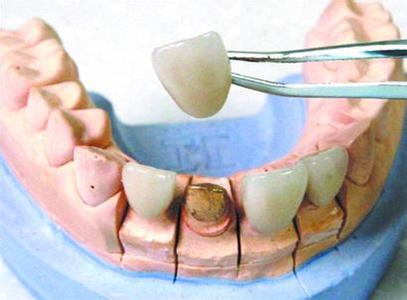 鑲牙有幾種方式