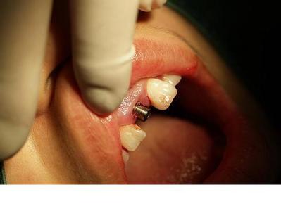 鑲牙有幾種方式